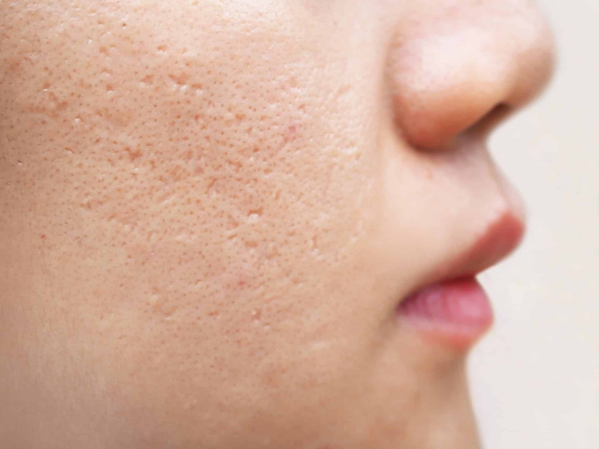 Deusaderm Collagen Fillers - Facial Depressions Acne Scars